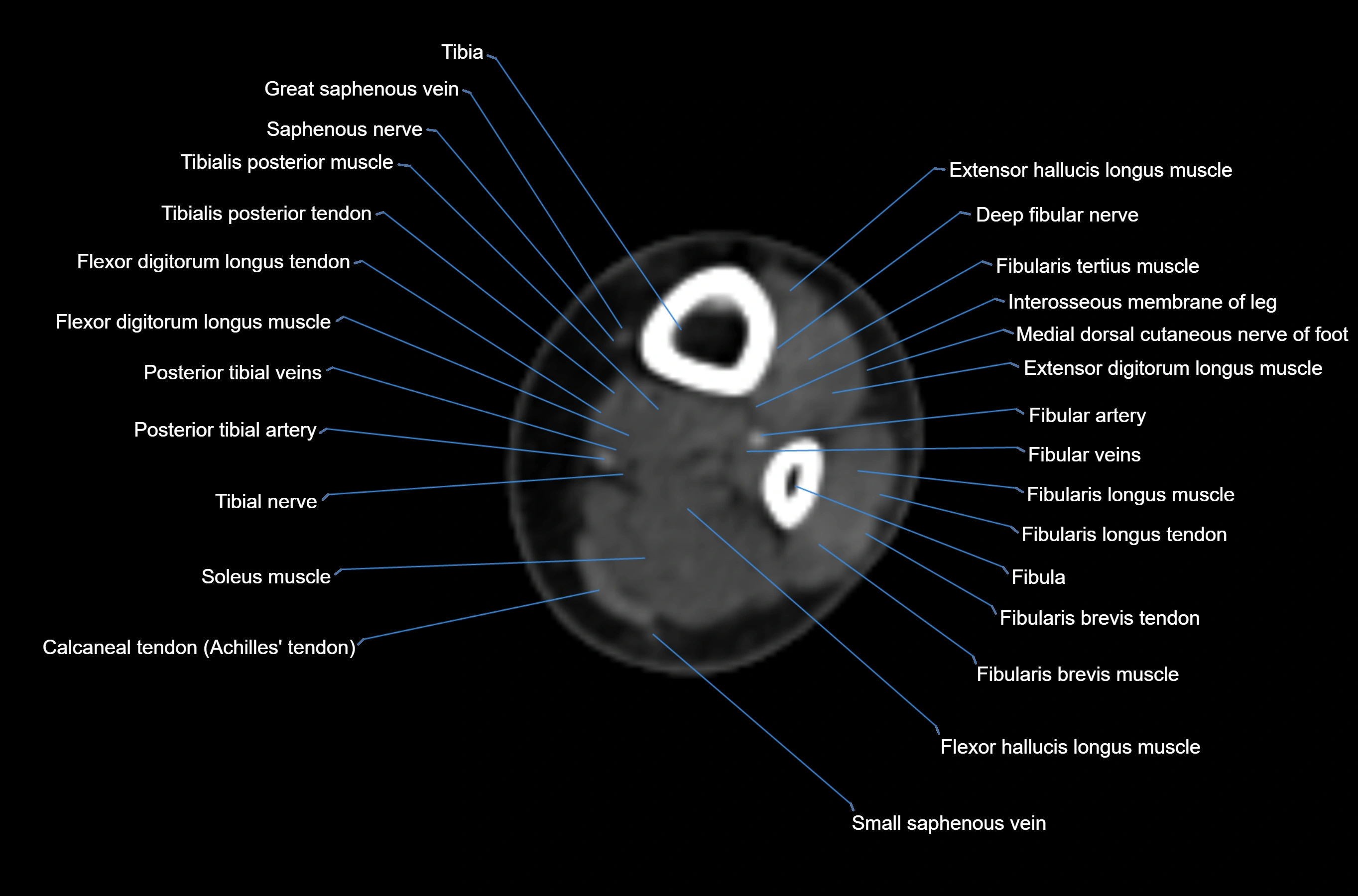 CT Ankle axial cross sectional anatomy labelled image -00001.webp